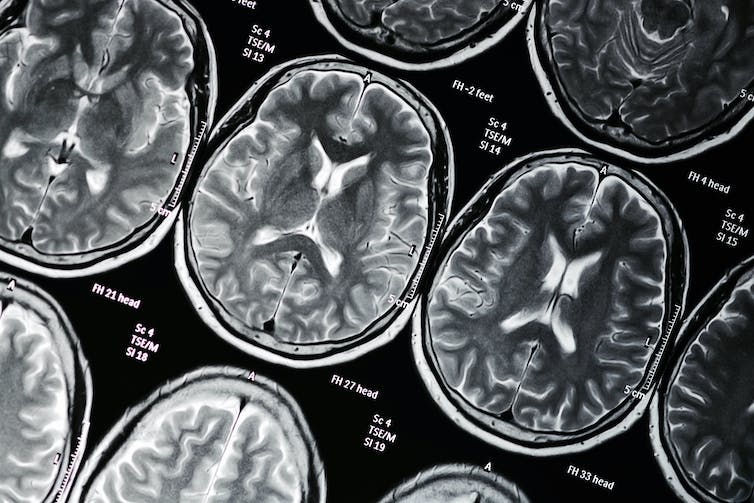 Imagen de escáner cerebral fMRI.